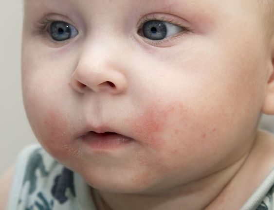 Trẻ bị ho ăn cháo ếch được không?