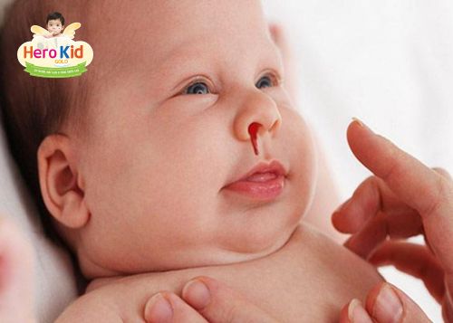 Hướng dẫn xử lý khi rửa mũi cho bé ra máuHướng dẫn xử lý khi rửa mũi cho bé ra máu