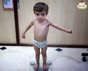 Cách điều trị bệnh biếng ăn ở trẻ em